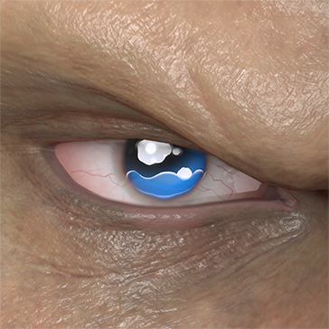 T_UI_CUS_CH_item_ccn_eye_teary